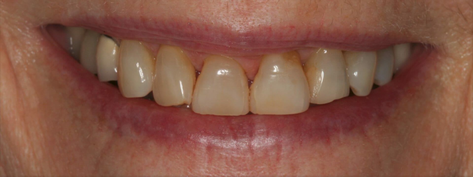 Martin Before