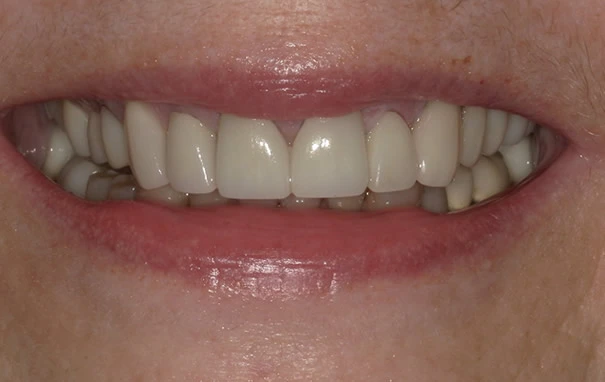 after smile close up jane