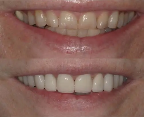 before and after smile close up dave