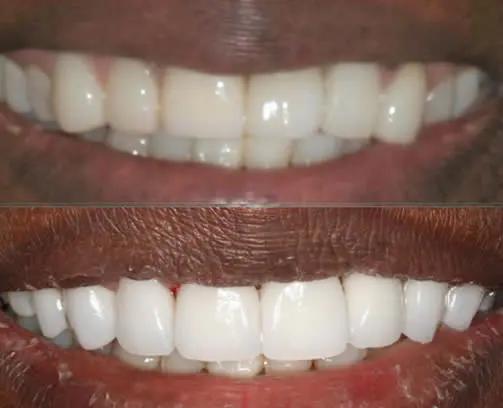 before and after smile close up jane
