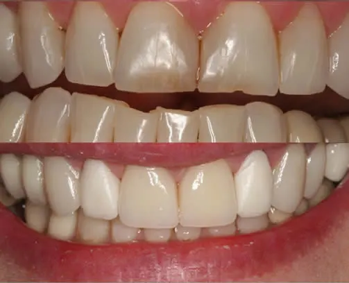 before and after smile close up steve