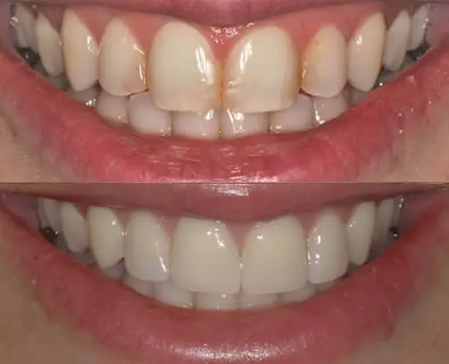 before and after smile close up tom